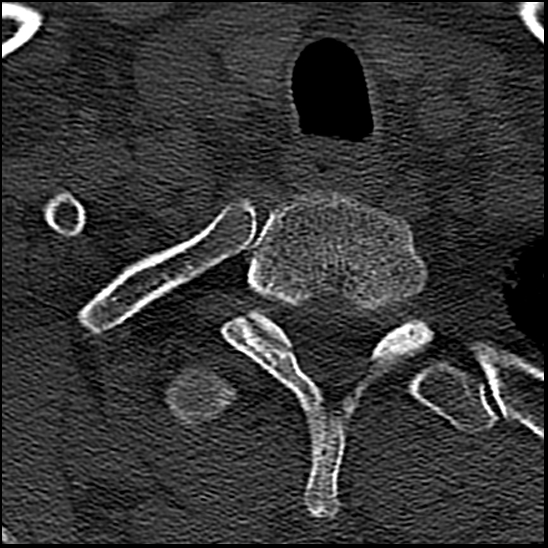 Occipital condyle fracture (type 1) (Radiopaedia 87670-104084 Axial bone window 88).jpg