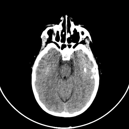 Occipital encephalocele (Radiopaedia 87339-103636 Axial non-contrast 30).jpg