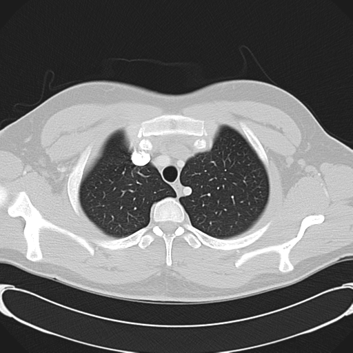 File:'Bovine' aortic arch (Radiopaedia 33554-34637 Axial lung window 12).png