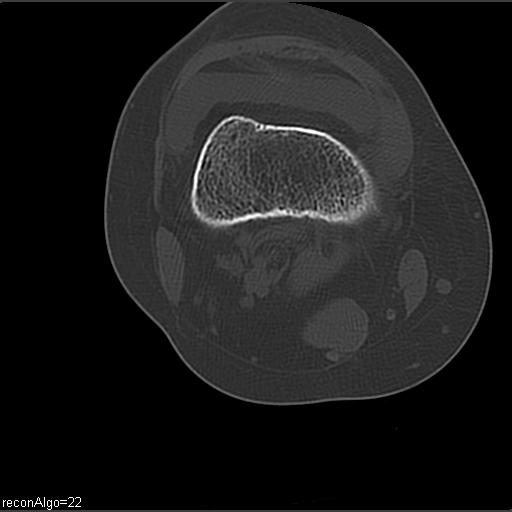 File:ACL avulsion fracture (Radiopaedia 33833-34994 Axial bone window 10).jpg