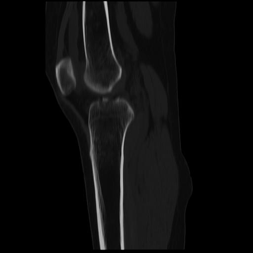 File:ACL avulsion fracture (Radiopaedia 33833-34994 Sagittal bone window 22).jpg