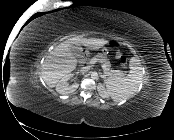 File:Abdominal abscess - pre and post percutaneous drainage (Radiopaedia 60209-67816 Axial 63).png