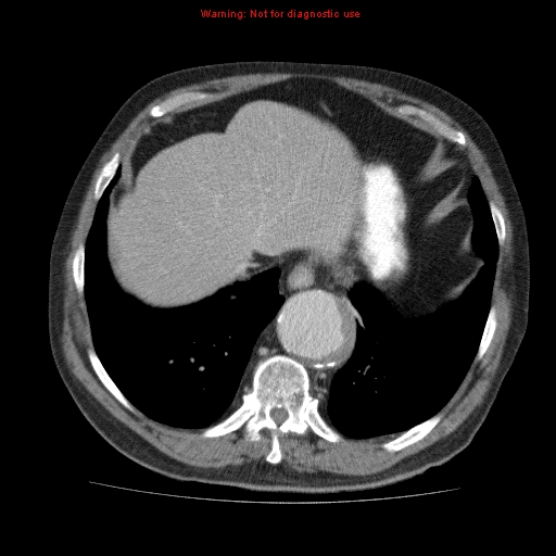 Abdominal aortic aneurysm (Radiopaedia 10122-10660 Axial C+ portal venous phase 9).jpg