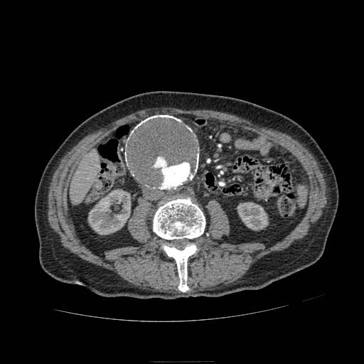 Abdominal aortic aneurysm (Radiopaedia 13341-13340 Axial C+ arterial phase 106).jpg