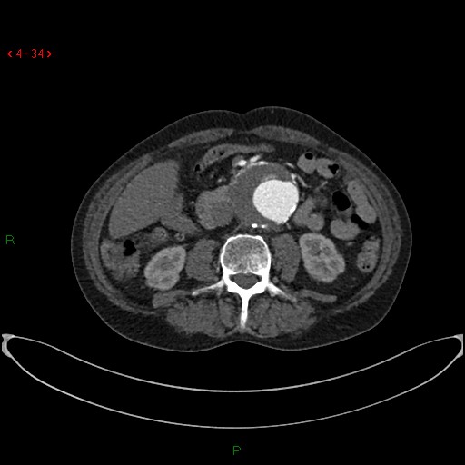 File:Abdominal aortic aneurysm (Radiopaedia 16155-15834 Axial C+ arterial phase 14).jpg