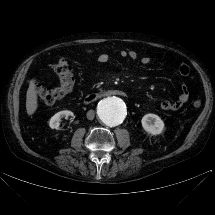 Abdominal aortic aneurysm (Radiopaedia 25855-26001 Axial C+ arterial phase 65).jpg