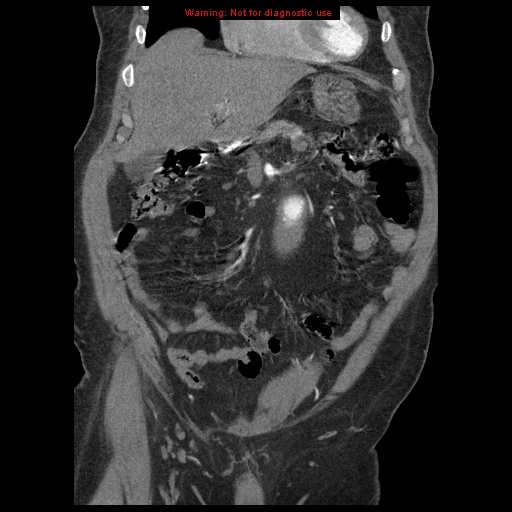 Abdominal aortic aneurysm (Radiopaedia 8190-9038 Coronal C+ arterial phase 36).jpg
