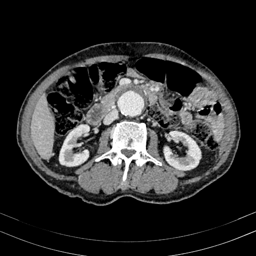 Abdominal aortic aneurysm (Radiopaedia 83581-98689 Axial C+ portal venous phase 52).jpg