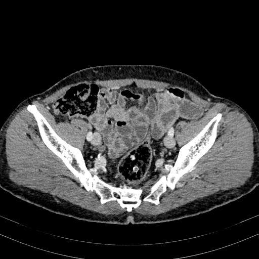 Abdominal aortic aneurysm (Radiopaedia 83581-98689 Axial C+ portal venous phase 92).jpg