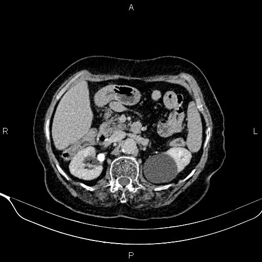 Abdominal aortic aneurysm (Radiopaedia 85063-100606 Axial C+ delayed 35).jpg