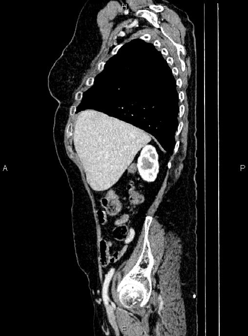 Abdominal aortic aneurysm (Radiopaedia 85063-100606 Sagittal C+ arterial phase 16).jpg