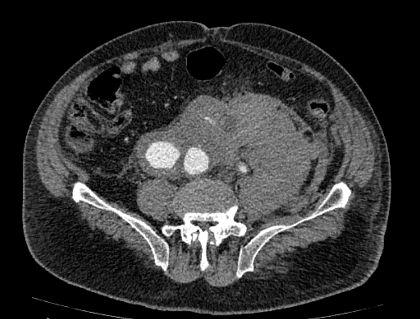 Abdominal aortic aneurysm rupture (Radiopaedia 54179-60362 Axial C+ portal venous phase 12).jpg
