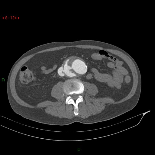 Abdominal aortic aneurysm rupture with aortocaval fistula (Radiopaedia 14897-14841 Axial C+ arterial phase 124).jpg