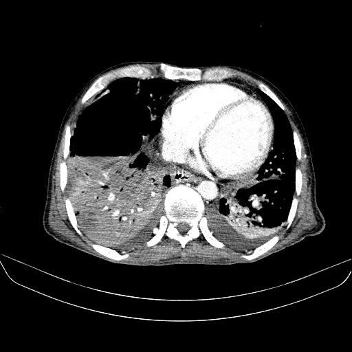 File:Abdominal collection due to previous cecal perforation (Radiopaedia 80831-94320 Axial C+ portal venous phase 6).jpg