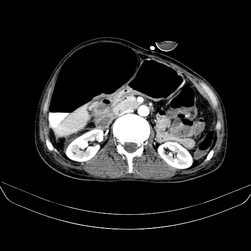 File:Abdominal collection due to previous cecal perforation (Radiopaedia 80831-94320 Axial C+ portal venous phase 84).jpg