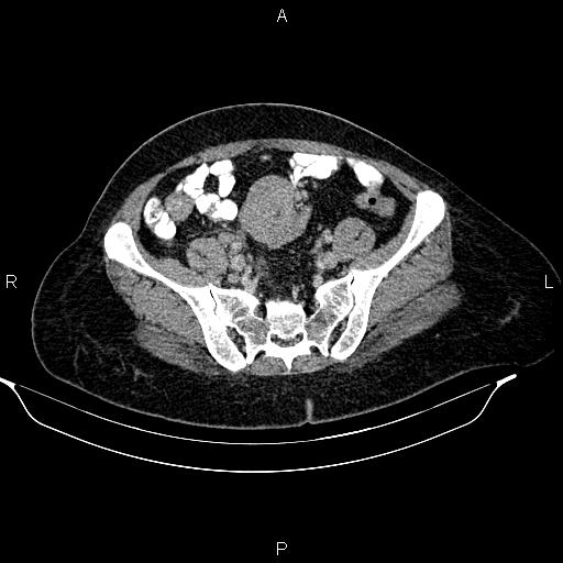 Abdominal lymphoma with sandwich sign (Radiopaedia 84378-99704 Axial C+ portal venous phase 44).jpg