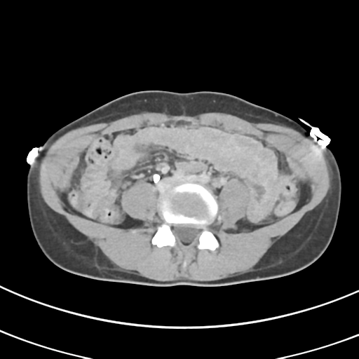 File:Abdominal multi-trauma - devascularised kidney and liver, spleen and pancreatic lacerations (Radiopaedia 34984-36486 Axial C+ delayed 49).png