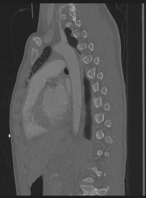 Abdominal multi-trauma - devascularised kidney and liver, spleen and pancreatic lacerations (Radiopaedia 34984-36486 Sagittal bone window 21).png