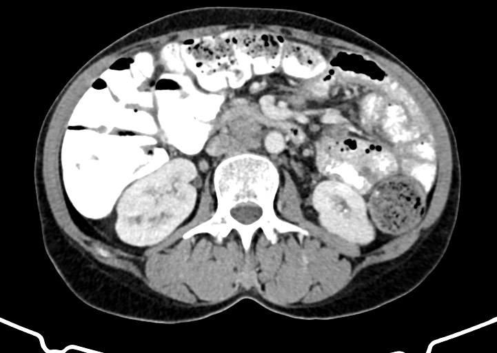 Abdominal wall and retroperitoneal tuberculosis (Radiopaedia 88137-104729 Axial C+ portal venous phase 89).jpg