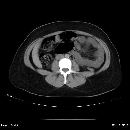 File:Abdominal wall endometriosis (Radiopaedia 25723-25885 Axial C+ portal venous phase 19).jpg