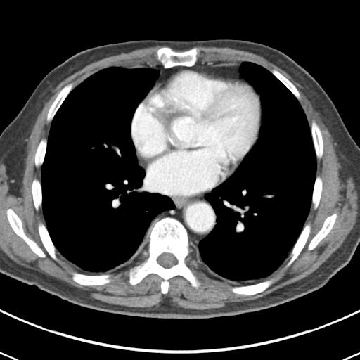 Abdominal wall metastasis from colorectal carcinoma (Radiopaedia 31016-31717 Axial C+ portal venous phase 1).jpg