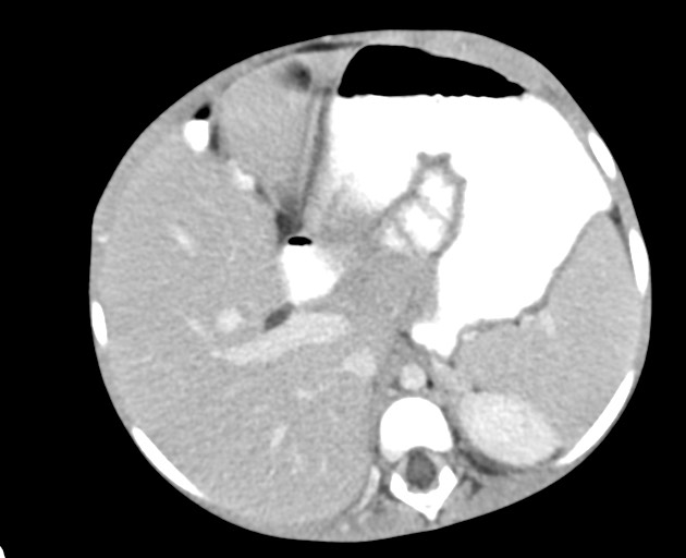 Abdominopelvic rhabdomyosarcoma (Radiopaedia 78356-90984 Axial C+ portal venous phase 55).jpg