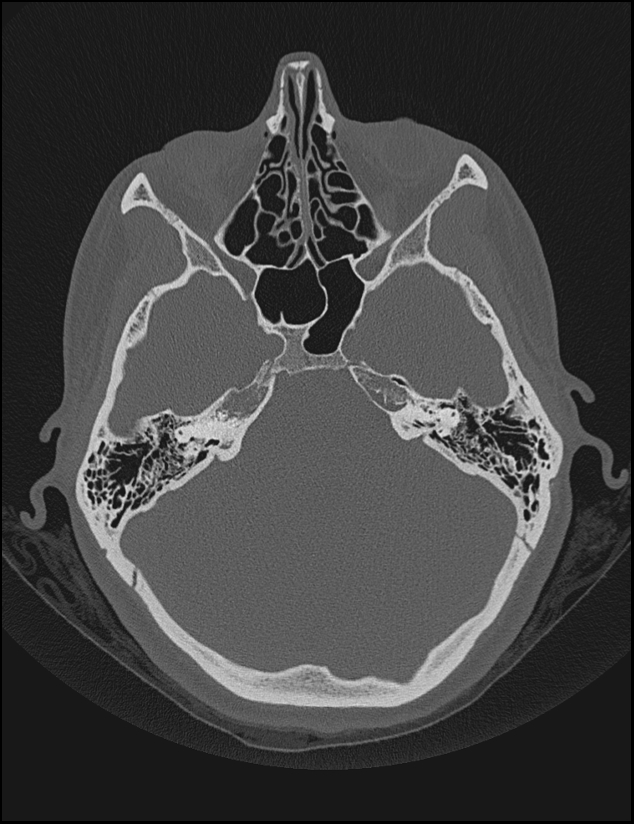 Aberrant right internal carotid artery (Radiopaedia 65191-74198 Axial non-contrast 53).jpg