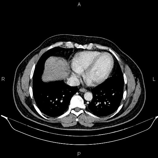 File:Aberrant right subclavian artery (Radiopaedia 87093-103354 Axial With contrast 80).jpg