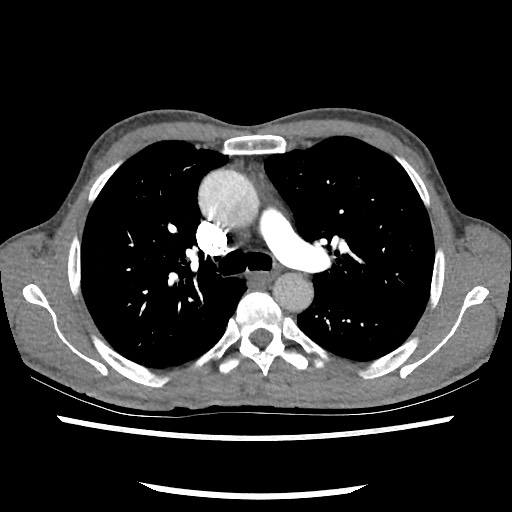 Accessory left horizontal fissure with lingular pneumonia (Radiopaedia 53763-59843 Axial C+ CTPA 38).jpg