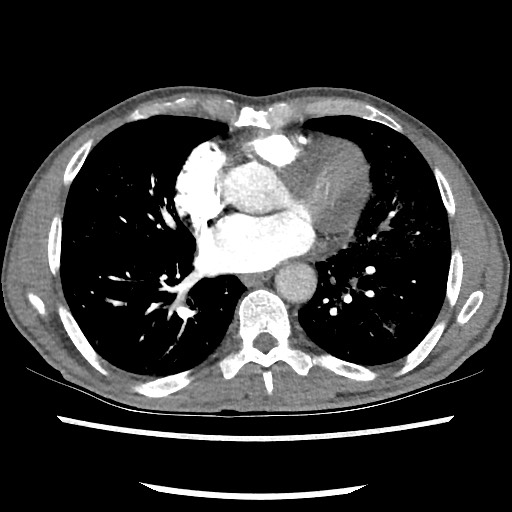 Accessory left horizontal fissure with lingular pneumonia (Radiopaedia 53763-59843 Axial C+ CTPA 58).jpg