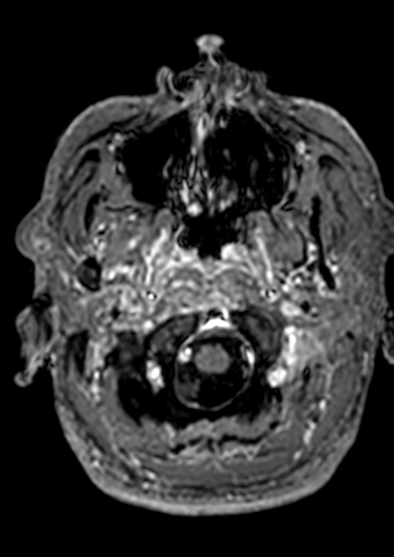 Accessory middle cerebral artery (Radiopaedia 73114-83828 Axial T1 C+ 188).jpg