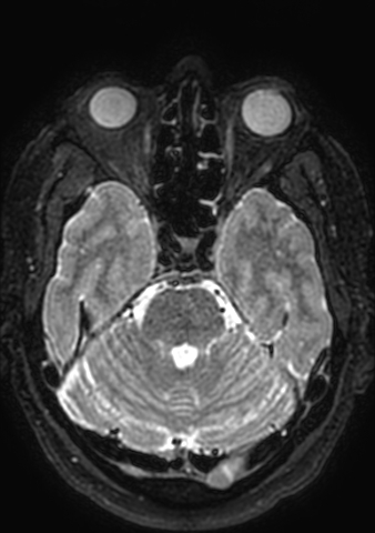 Accessory middle cerebral artery (Radiopaedia 73114-83828 Axial T2 145).jpg