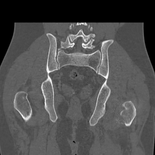 File:Acetabular and ilial fractures (Radiopaedia 59084-66378 Coronal bone window 38).jpg