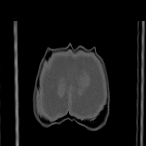 Acetabular and ilial fractures (Radiopaedia 59084-66378 Coronal bone window 59).jpg