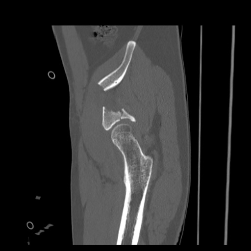 Acetabular and ilial fractures (Radiopaedia 59084-66378 Sagittal bone window 17).jpg