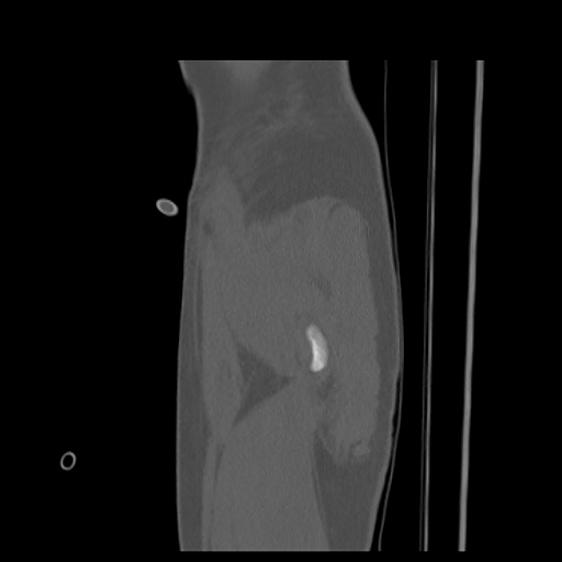Acetabular and ilial fractures (Radiopaedia 59084-66378 Sagittal bone window 4).jpg