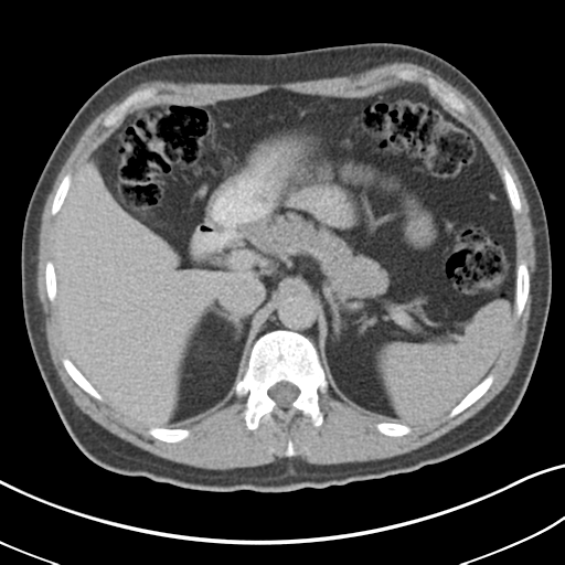 Achalasia of the cardia (Radiopaedia 38497-40595 Axial C+ portal venous phase 24).png
