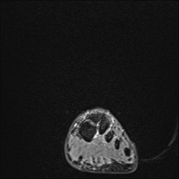 File:Achilles tendon tear (Radiopaedia 77615-89819 Coronal STIR 2).jpg