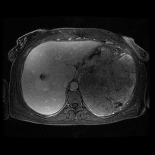 Acinar cell carcinoma of the pancreas (Radiopaedia 75442-86668 D 106).jpg