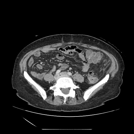 File:Acinar cell carcinoma of the pancreas (Radiopaedia 75442-86669 Axial C+ portal venous phase 97).jpg