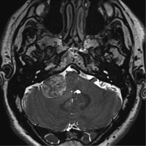 File:Acoustic schwannoma (Radiopaedia 50846-56358 Axial T2 15).png