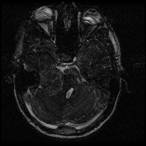 Acoustic schwannoma - eroding petrous apex (Radiopaedia 39674-42004 Axial T2 56).png