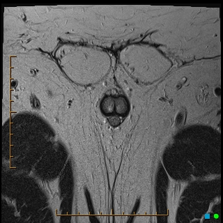 File:Acquired buried penis (Radiopaedia 39478-41797 Axial T2 16).jpg