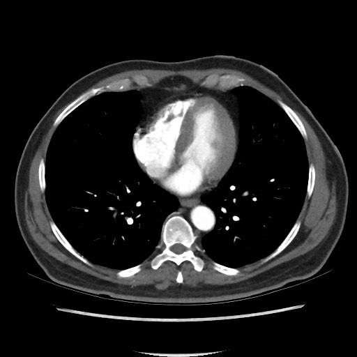 File:Active colonic bleed on CT (Radiopaedia 49765-55025 Axial C+ arterial phase 2).jpg