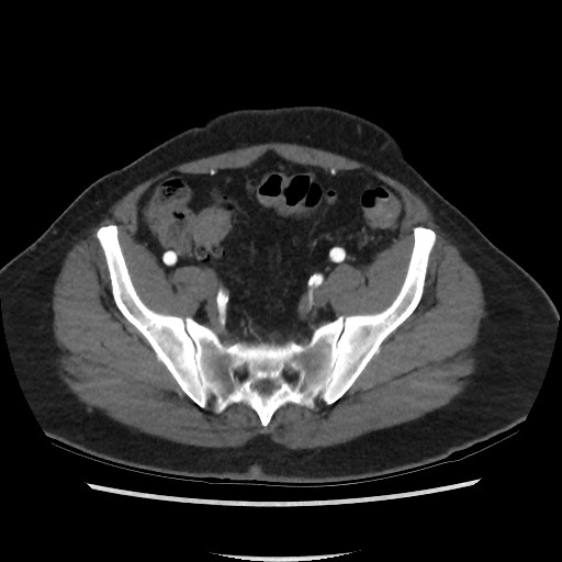 Active colonic bleed on CT (Radiopaedia 49765-55025 Axial C+ arterial phase 65).jpg