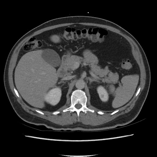 File:Active colonic bleed on CT (Radiopaedia 49765-55025 Axial C+ delayed 26).jpg