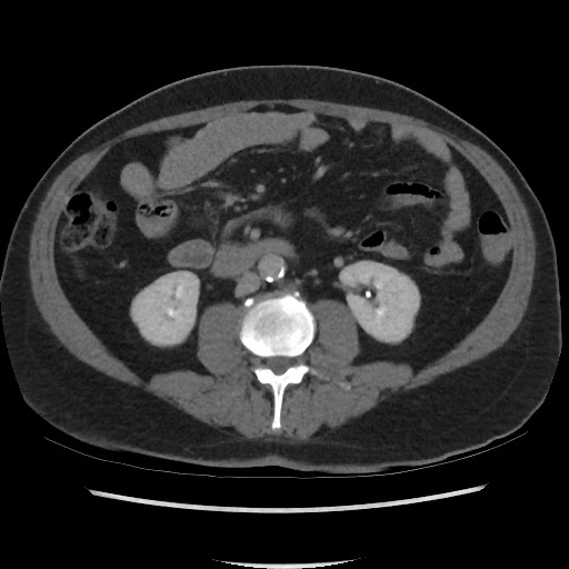 File:Active colonic bleed on CT (Radiopaedia 49765-55025 Axial C+ delayed 42).jpg
