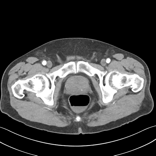 File:Active diverticular hemorrhage (Radiopaedia 39415-41725 Axial C+ arterial phase 70).png