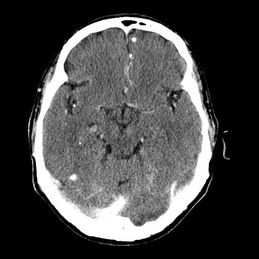 File:Active neurocysticercosis before and after therapy (Radiopaedia 71710-82099 Axial C+ delayed 64).jpg