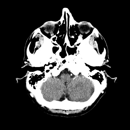 File:Active neurocysticercosis before and after therapy (Radiopaedia 71710-82100 Axial C+ delayed 9).jpg